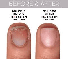 Nail repair