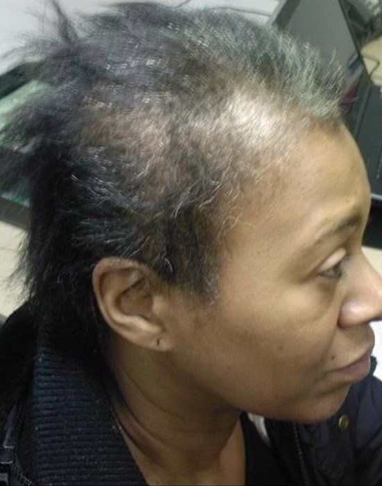 How Jada Pinkett Smith is uplifting Black women with alopecia