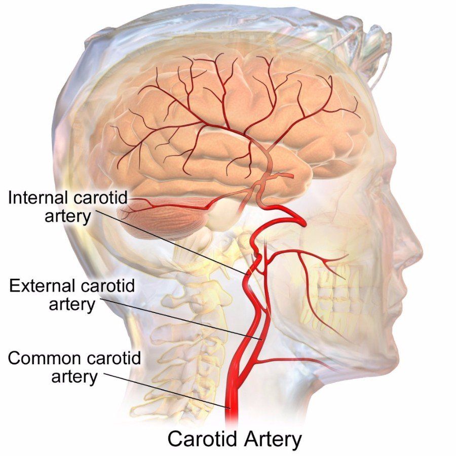Cervical Artery Dissection