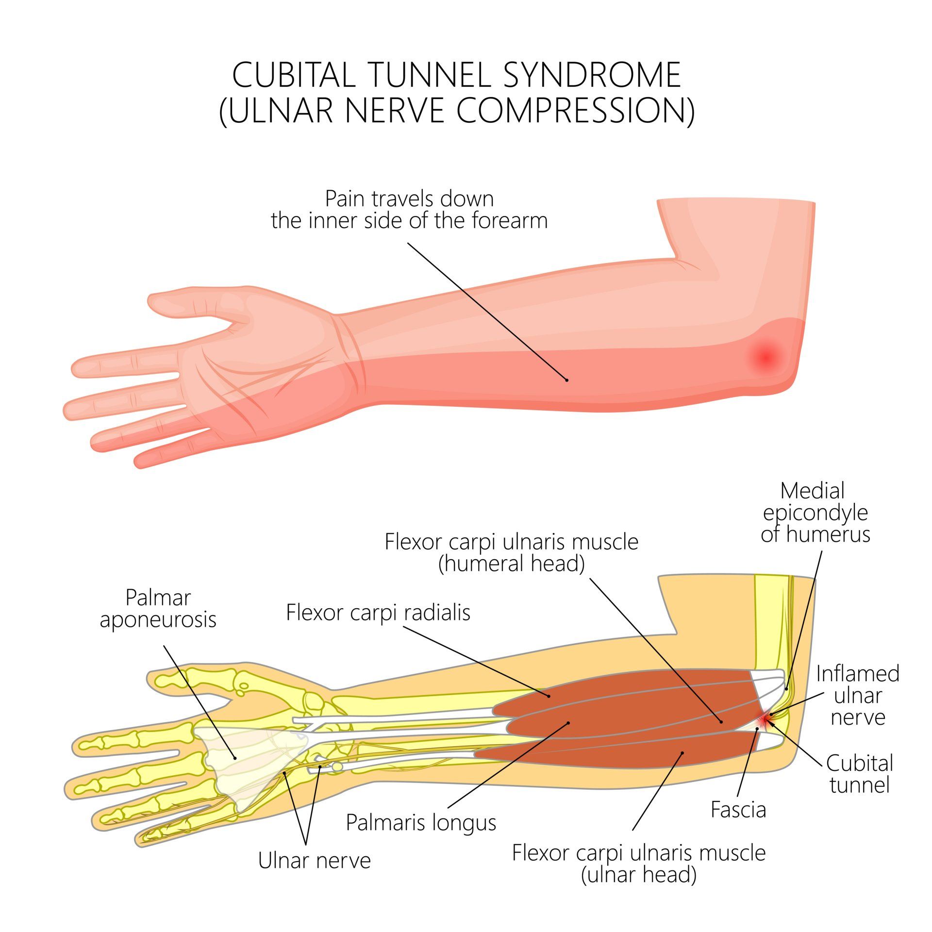 Nerve Entrapment Injury And Neuropathy Ulnar Nerve