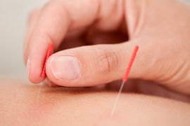 Medical Acupuncture in Luton