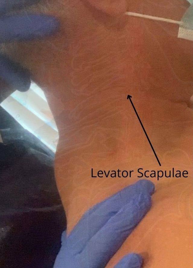 Neck Pain and Levator Scapulae Syndrome