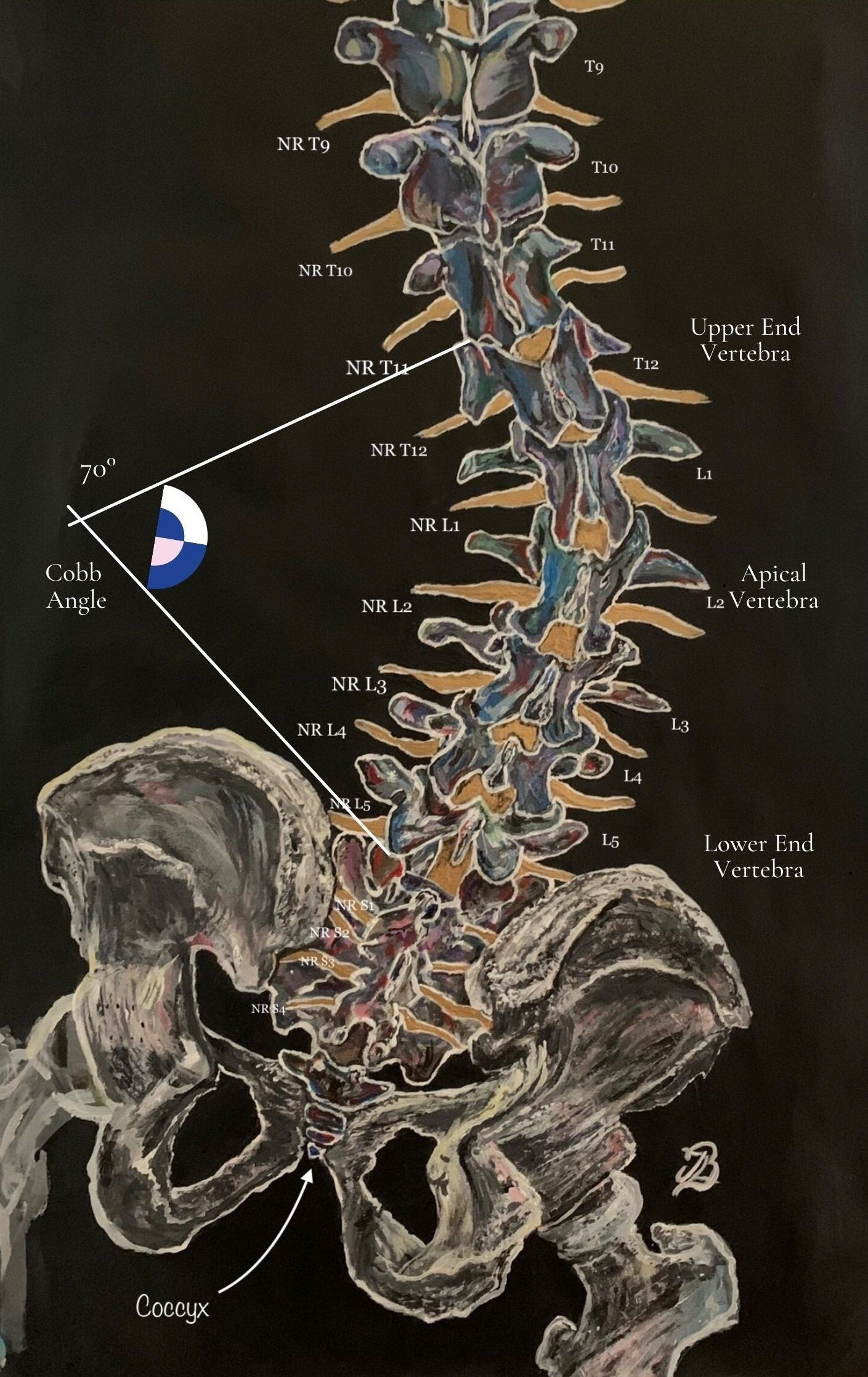 scoliosis of the spine