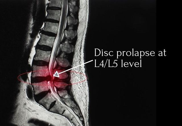 Lower Back Pain & The Herniated Disc