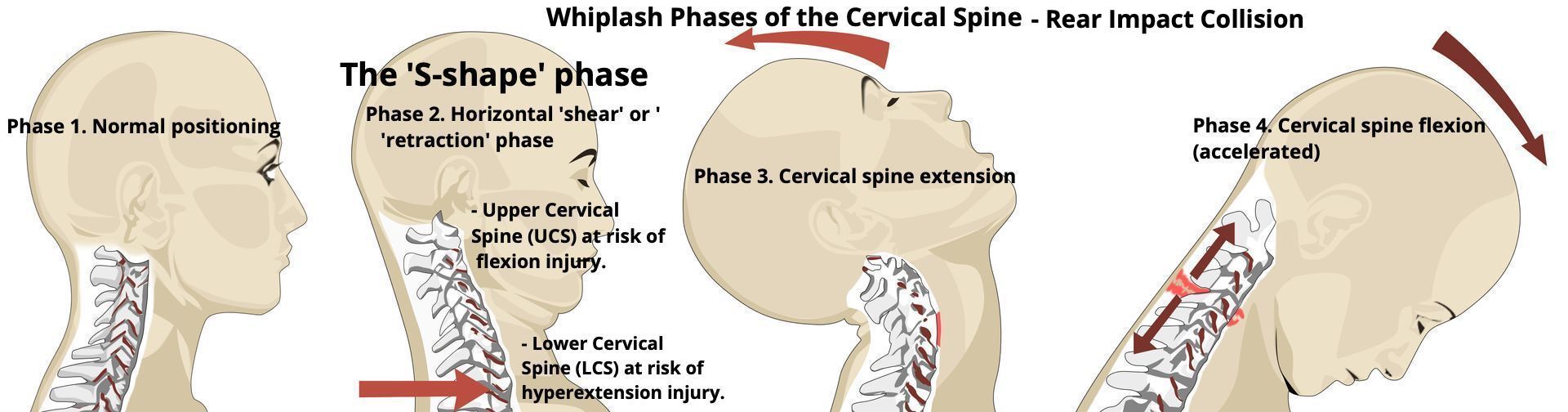 stages of whiplash injury 