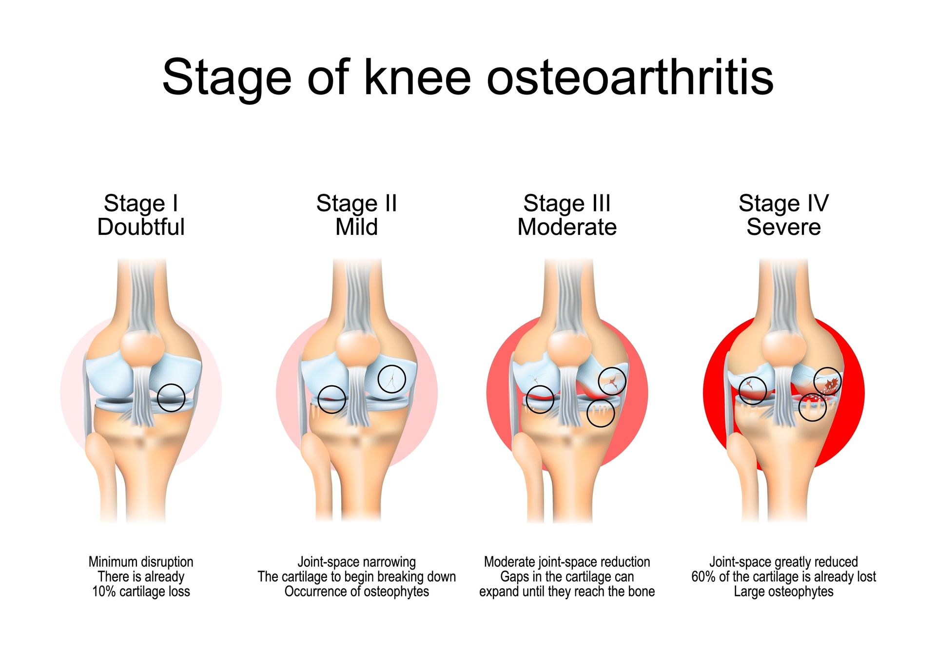 Osteoarthritis within the knee 
