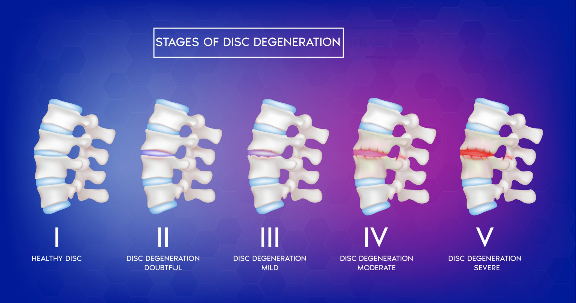disc degeneration stages