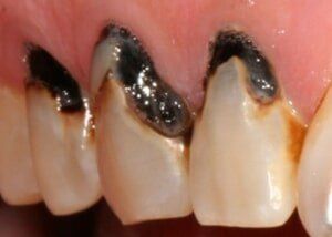 Composite fillings to restore decay - Before — Teeth and Gums in Lincolnton, NC
