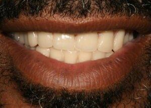 Upper and lower dentures to restore function and smile - After — Teeth and Gums in Lincolnton, NC