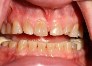 All porcelain crowns and bonding to restore wear - Before — Teeth and Gums in Lincolnton, NC