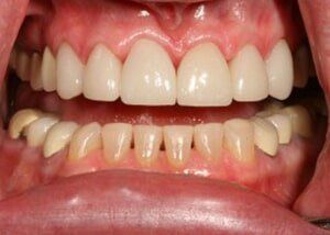 All porcelain crowns and bonding to restore wear - After — Teeth and Gums in Lincolnton, NC