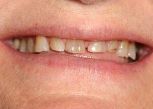 All porcelain crowns to restore smile - Before — Teeth and Gums in Lincolnton, NC