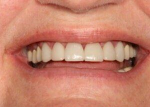 All porcelain crowns to restore smile - After — Teeth and Gums in Lincolnton, NC