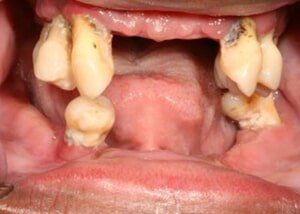 Upper and lower dentures to restore function and smile - Before — Teeth and Gums in Lincolnton, NC