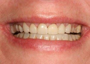Crowns Restoration - after — Teeth and Gums in Lincolnton, NC