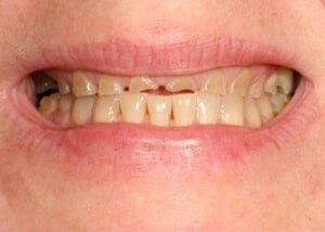 Crowns Restoration - before — Teeth and Gums in Lincolnton, NC