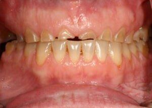 Porcelain crowns restore - before — Teeth and Gums in Lincolnton, NC