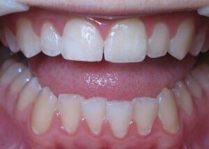 Porcelain crowns - after — Teeth and Gums in Lincolnton, NC