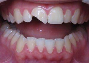 Porcelain crowns - before — Teeth and Gums in Lincolnton, NC