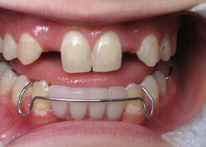 Bridge to replace missing laterals - Before — Teeth and Gums in Lincolnton, NC