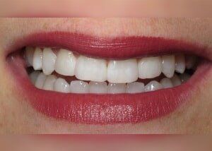 Cosmetic bonding to close spacing - After — Teeth and Gums in Lincolnton, NC