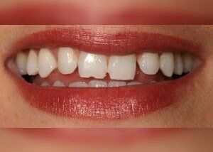 Cosmetic bonding to close spacing - Before — Teeth and Gums in Lincolnton, NC