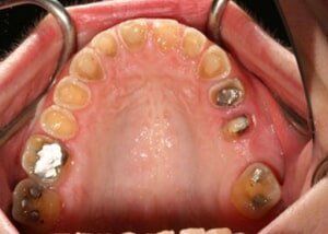All porcelain crowns, bridges and composite restorations - Before — Teeth and Gums in Lincolnton, NC