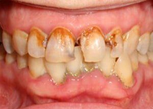 Composite fillings to restore decay - Before — Teeth and Gums in Lincolnton, NC