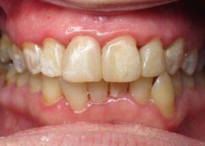 Composite fillings to restore decay - After — Teeth and Gums in Lincolnton, NC