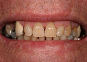 Porcelain bridge to replace missing teeth - Before — Teeth and Gums in Lincolnton, NC