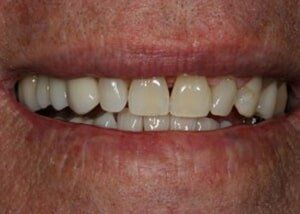 Porcelain bridge to replace missing teeth - After — Teeth and Gums in Lincolnton, NC