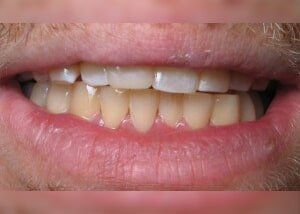 Bonding to lengthen tooth contour - After — Teeth and Gums in Lincolnton, NC