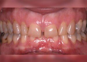 Orthodontic treatment and all porcelain crowns to restore bite and smile - Before — Teeth and Gums in Lincolnton, NC