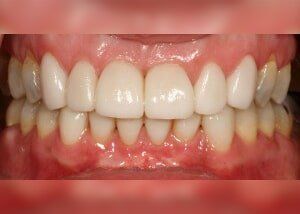 Orthodontic treatment and all porcelain crowns to restore bite and smile - After — Teeth and Gums in Lincolnton, NC