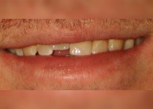 Bonding to lengthen tooth contour - Before — Teeth and Gums in Lincolnton, NC