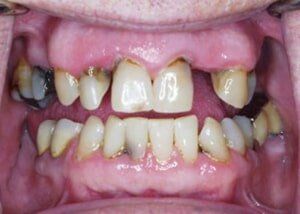 Porcelain bridge and crowns to restore smile - Before — Teeth and Gums in Lincolnton, NC