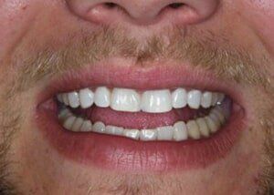 Bonding to close diastema - After — Teeth and Gums in Lincolnton, NC