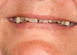 All porcelain crowns to restore smile - Before — Teeth and Gums in Lincolnton, NC