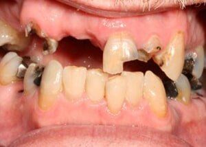 Porcelain bridge to restore smile - Before — Teeth and Gums in Lincolnton, NC