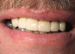 Porcelain bridge to restore smile - After — Teeth and Gums in Lincolnton, NC