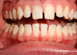 Cosmetic bonding to close spacing - Before — Teeth and Gums in Lincolnton, NC