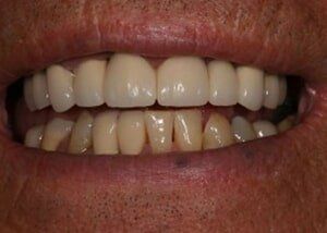Porcelain bridge and crowns to restore smile - After — Teeth and Gums in Lincolnton, NC