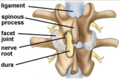 Laminotomy Laminectomy Illustration