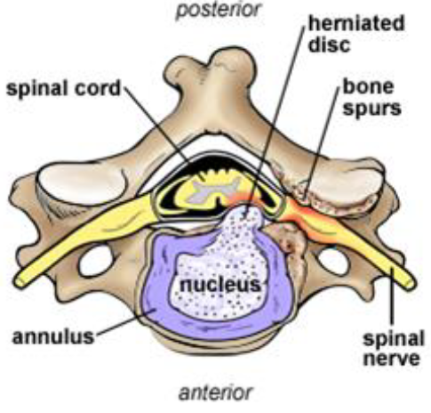 ACDF  Spinal Fusion Interior