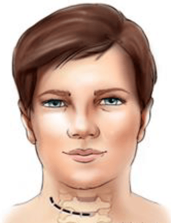 ACDF Image 2 Neck Photo