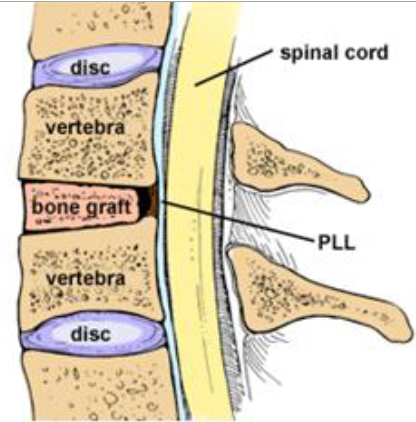ACDF Spinal Fusion Interior Illustration