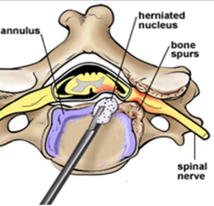 ACDF Spinal Fusion Interior View
