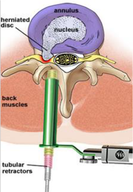 Herniated Disc Discectomy Herniated Disc Discectomy
