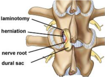 Laminotomy Graphic