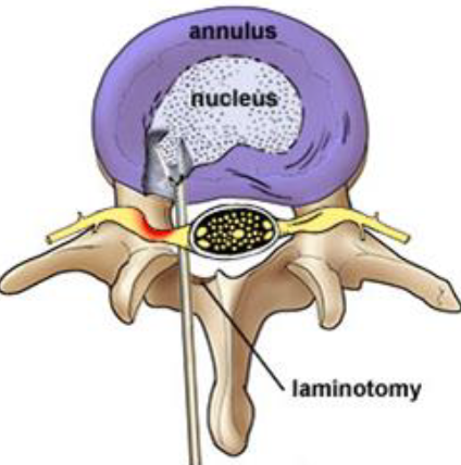 Discectomy Herniated Disk Image